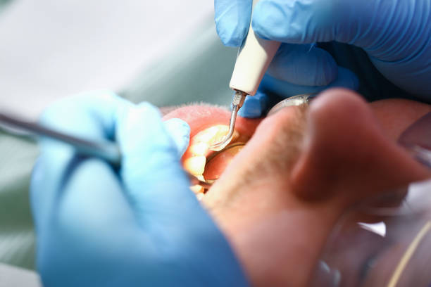 Best Emergency Dentist for Lost Fillings or Crowns in Point Lookout, NY